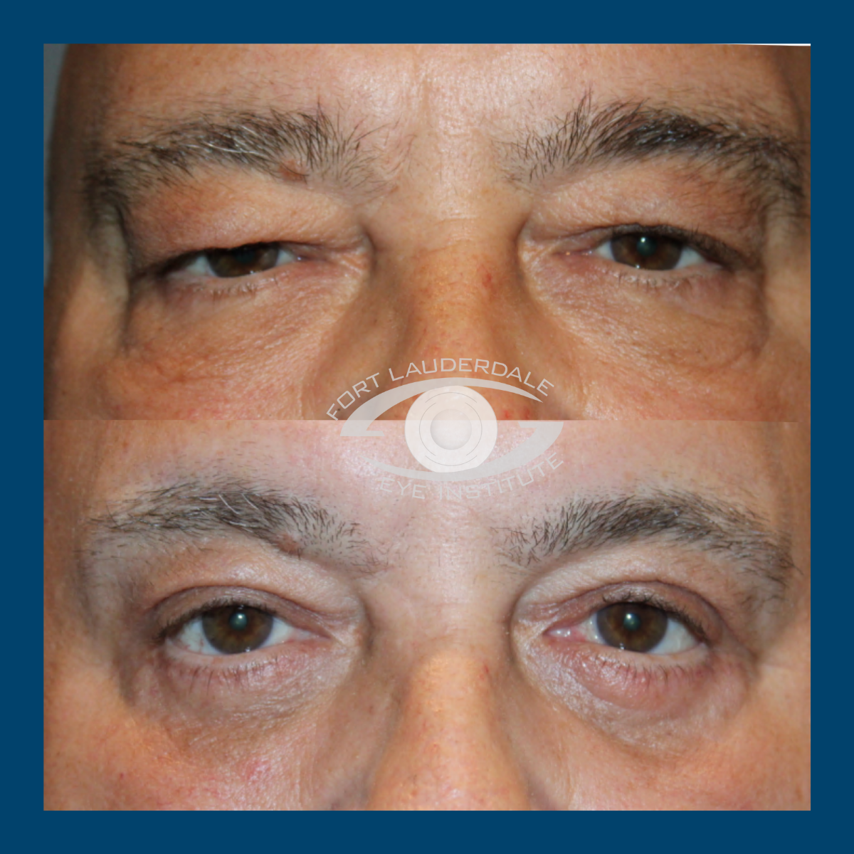 pt7 upper lower bleph