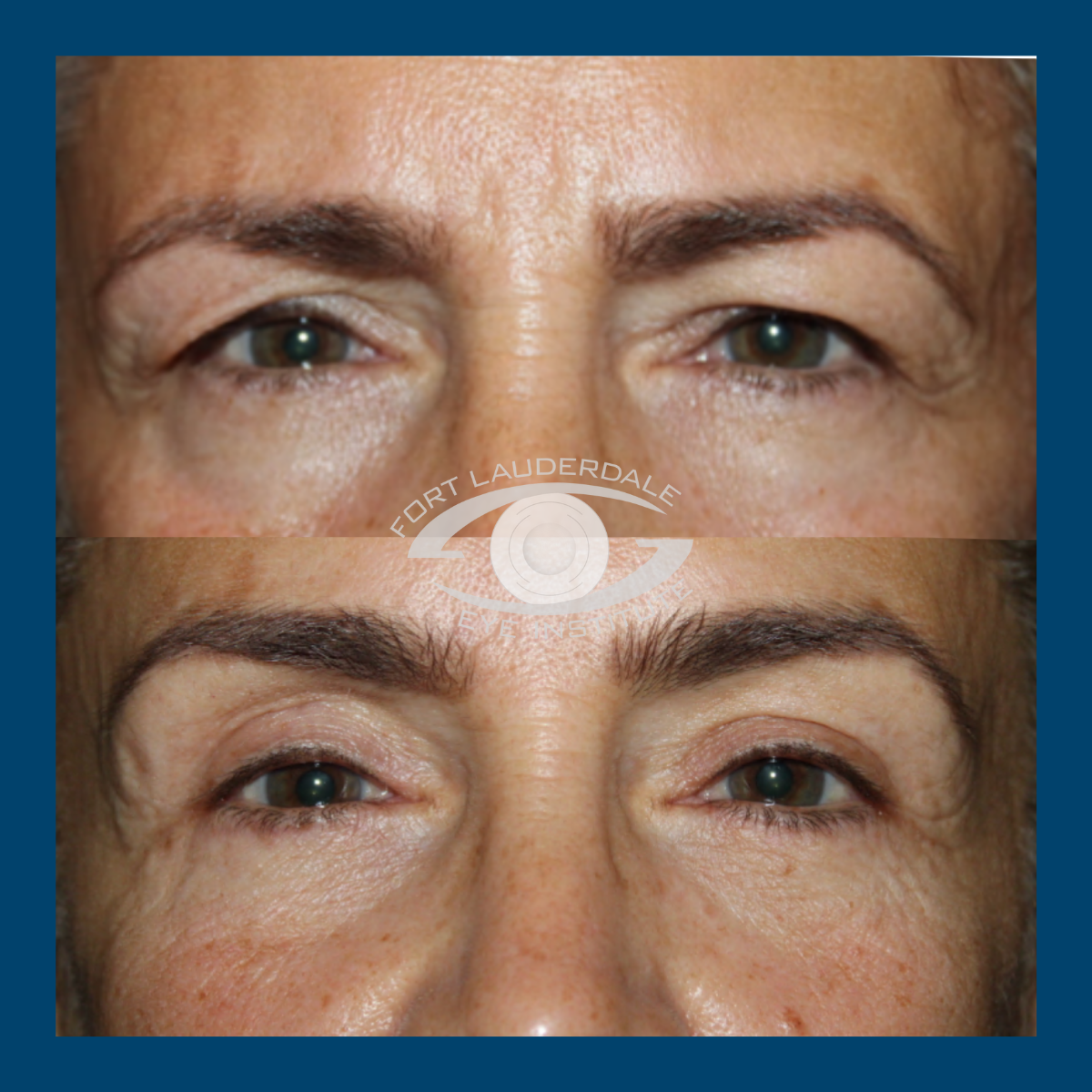 pt8 upper lower bleph