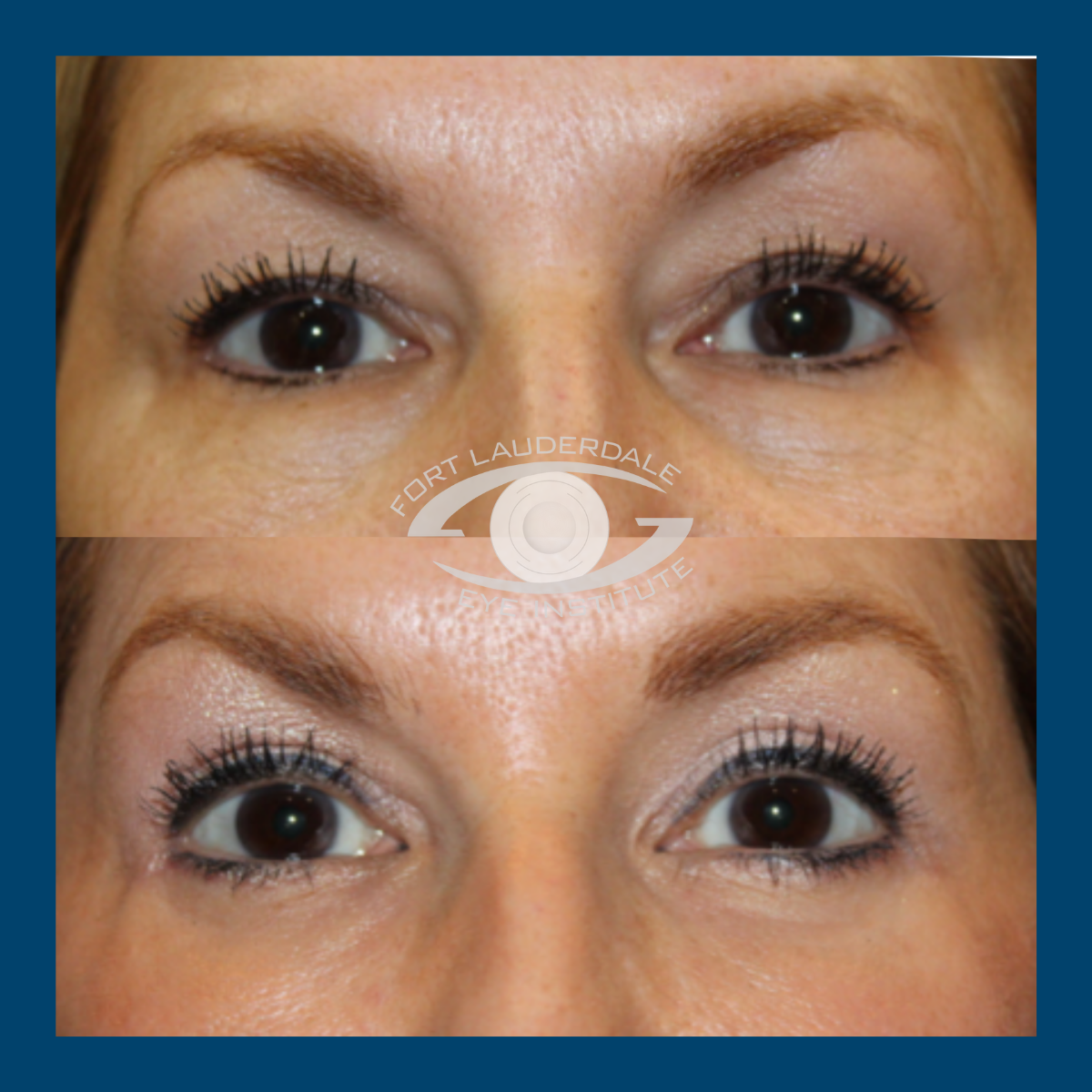 pt9 upper lower bleph