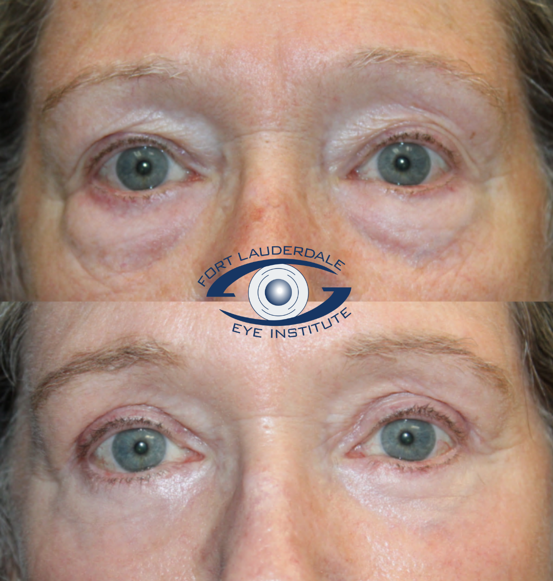 Upper Lower Blep and Laser 1