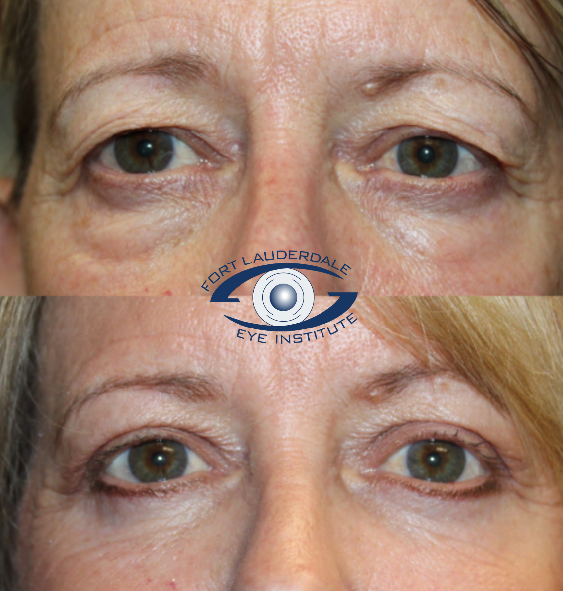 Upper Lower Blep and Laser 2