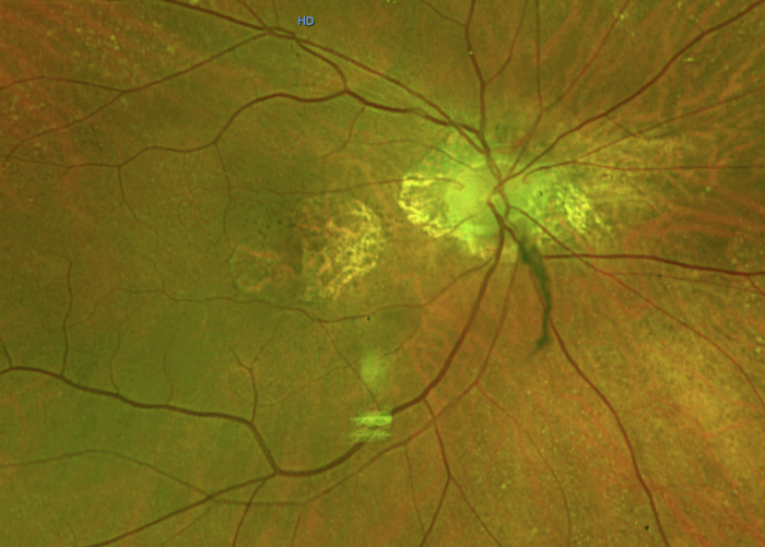 advanced macular degeneration: what you need to know 2 geographic atropy