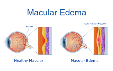 macular edema