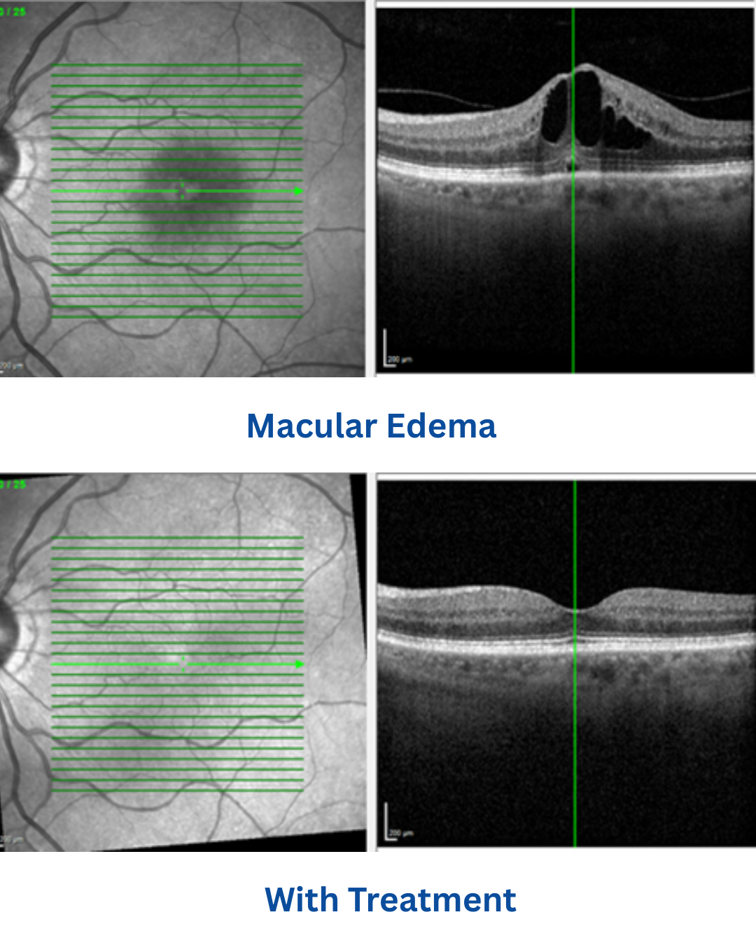 diabetic macular edema (dme): causes, symptoms, diagnosis, and treatment 2 Macular Edema with Treatment