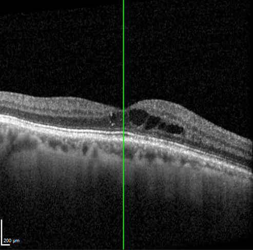 OCT scan shows retinal changes associated with diabetic retinopathy