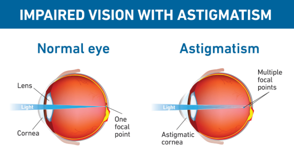 astigmatism verus normal eye
