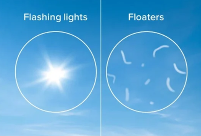 flashes and floaters symptoms 2 Flashes and Floaters