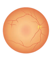 stages of diabetic retinopathy 2 Mild NonProliferative Retinopathy