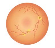 stages of diabetic retinopathy 3 Moderate Non Proliferative Retinopathy