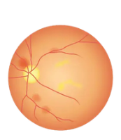 stages of diabetic retinopathy 5 Proliferative Retinopathy