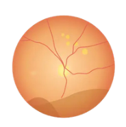 Severe Non Proliferative Retinopathy