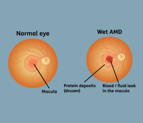 Wet AMD vs Normal Eye