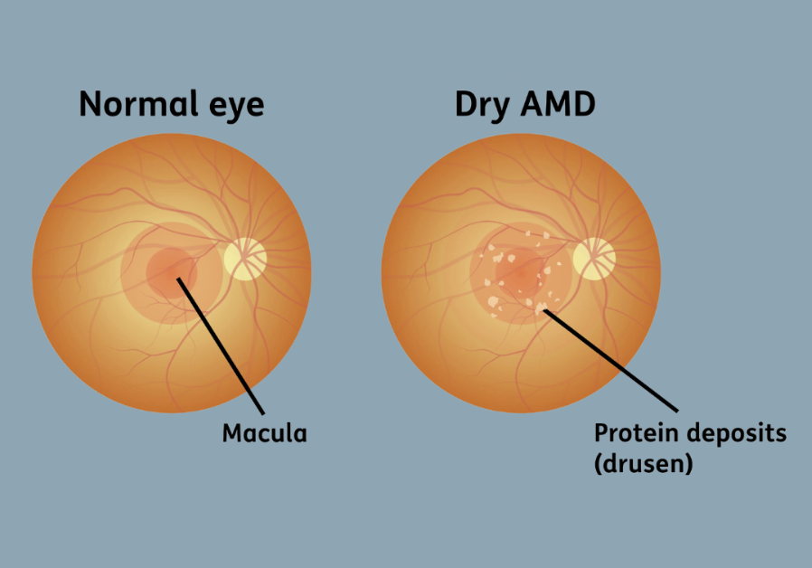 dry amd 2 dry amd eye